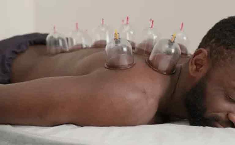Cupping